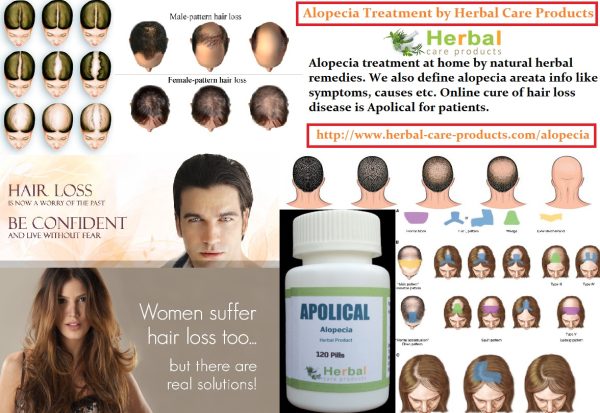 Natural Herbal Treatment for Alopecia Areata and Symptoms, Causes