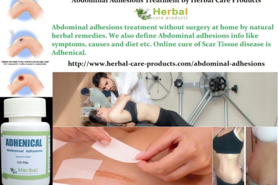 11-Natural-Home-Remedies-for-Abdominal-Adhesions