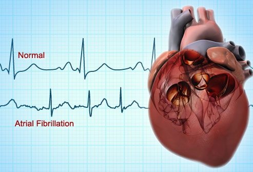 11 Natural Treatments for atrial fibrillation