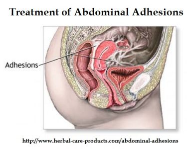 Abdominal-Adhesions