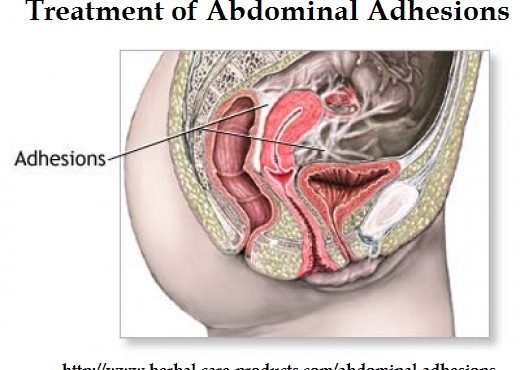 Abdominal-Adhesions