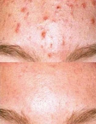 Actinic Keratosis Natural Treatment