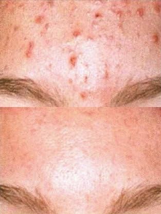 Actinic Keratosis Natural Treatment