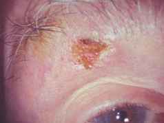 Actinic-Keratosis-on-the-Eyelids-1