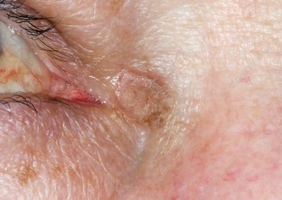 Actinic Keratosis on the Eyelids