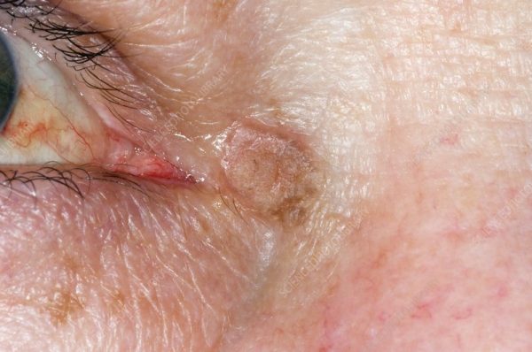 Actinic Keratosis on the Eyelids: Protect Your Eyelids