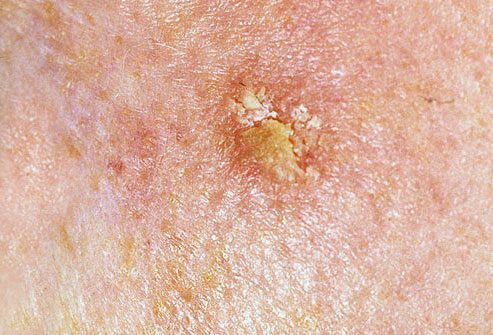 Actinic Keratosis – Actinic Cheilitis