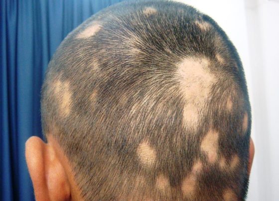 Alopecia – Youthful hair loss problem
