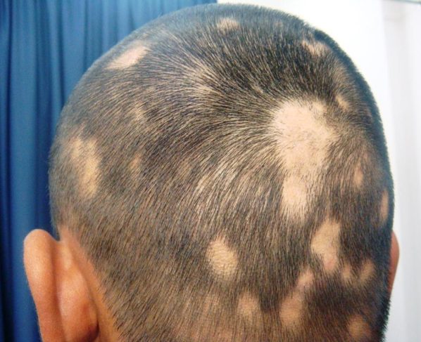 Alopecia – Youthful hair loss problem