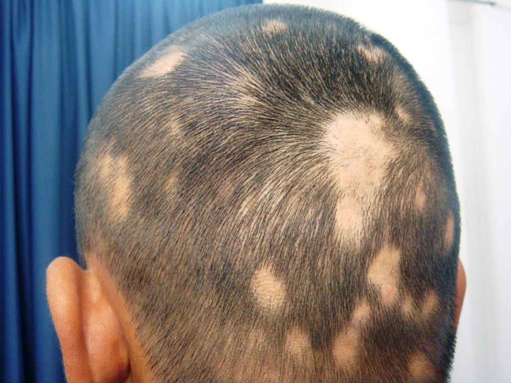 Alopecia – Youthful hair loss problem