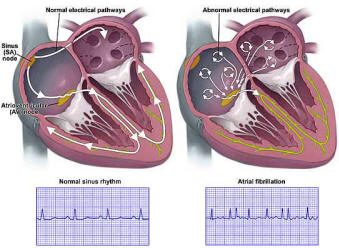 Atrial Fibrillation Symptoms, Causes, Diagnosis, Treatment