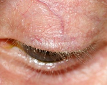 Blepharitis Symptoms, Causes, Diagnosis, and Treatment