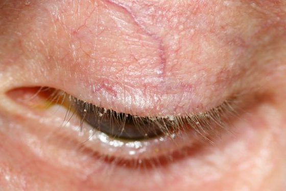 Blepharitis Symptoms, Causes, Diagnosis, and Treatment