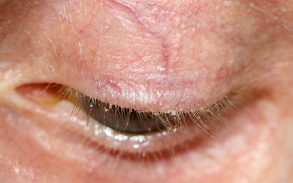 Blepharitis Symptoms, Causes, Diagnosis, and Treatment