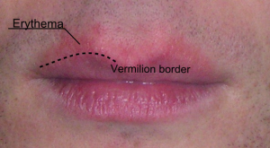 Blurring of lip border