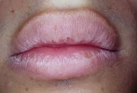 Blurring of lip border and adjacent skin
