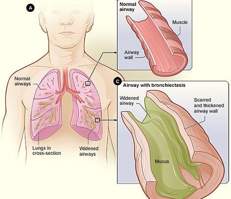 Bronchiectasis Symptoms, Causes, Prognosis