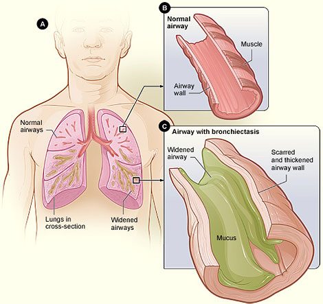 Bronchiectasis Symptoms, Causes, Prognosis, and Treatment