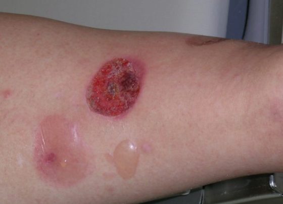 Bullous Pemphigoid