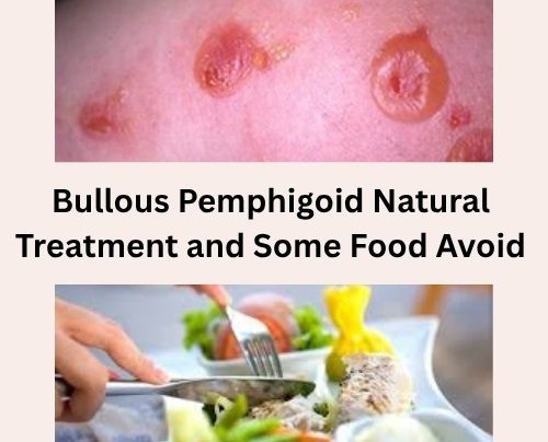 Bullous Pemphigoid Natural Treatment and Some Food Avoid