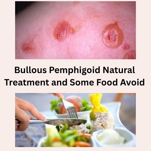 Bullous Pemphigoid Natural Treatment and Some Food Avoid