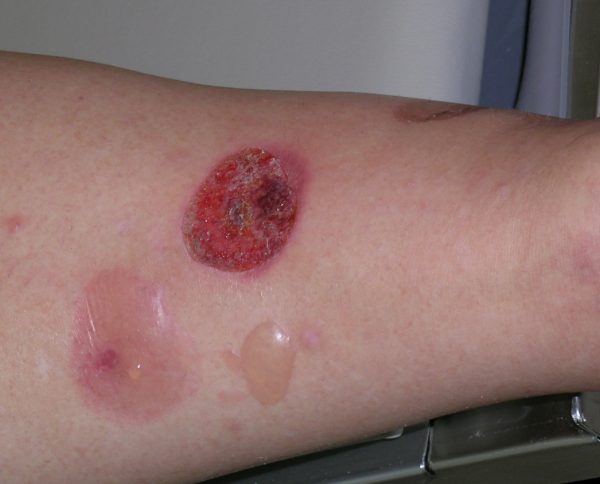 Bullous Pemphigoid – Autoimmune Skin Disorder
