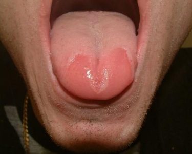 Burning Mouth Syndrome - Xerostomia