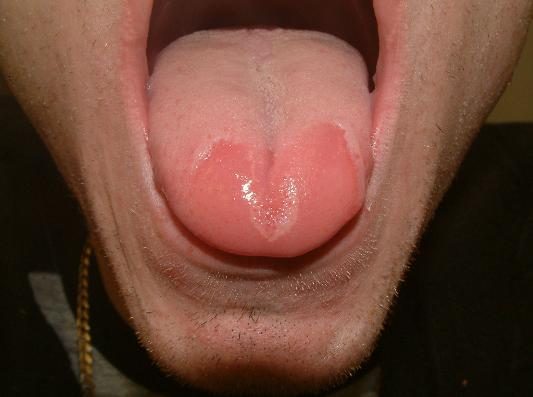 Burning Mouth Syndrome - Xerostomia