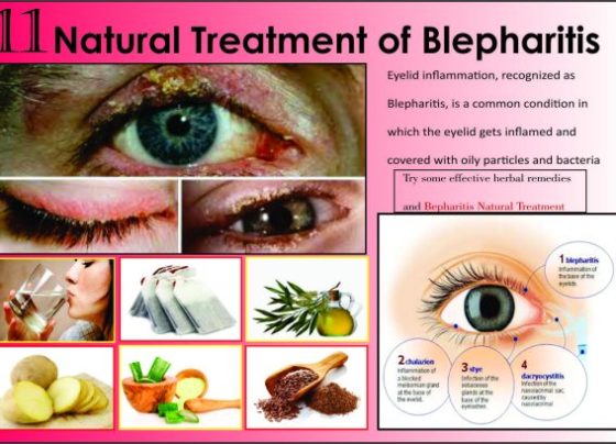 Easy Home Remedies for Eye Infection Blepharitis