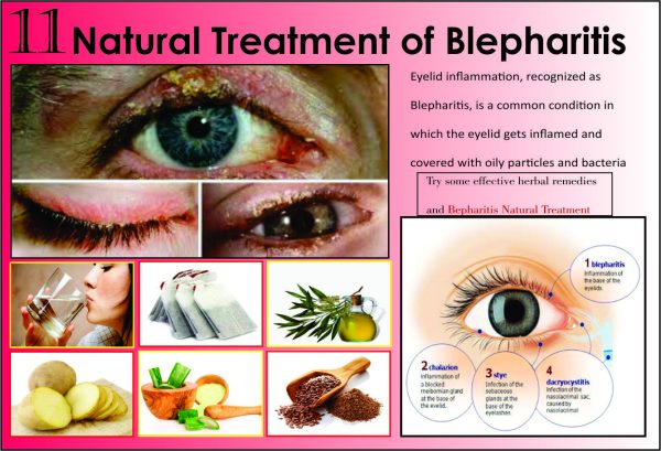 Easy Home Remedies for Eye Infection Blepharitis