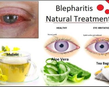 How to Cure Blepharitis Fast and Naturally with Herbal Remedies