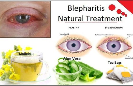 How to Cure Blepharitis Fast and Naturally with Herbal Remedies