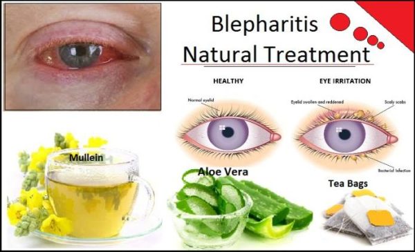 How to Cure Blepharitis Fast and Naturally with Herbal Remedies