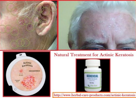 Natural Herbal Treatment for Actinic Keratosis