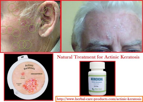 Natural Herbal Treatment for Actinic Keratosis and Symptoms, Causes