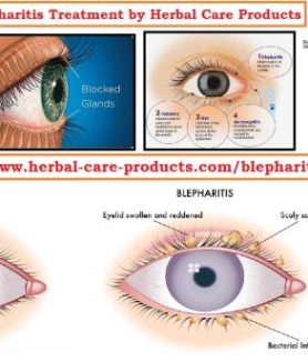 Natural Remedies for Blepharitis Affecting the Eyelids
