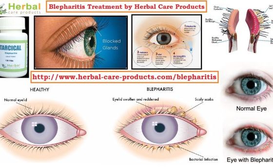 Natural Remedies for Blepharitis Affecting the Eyelids