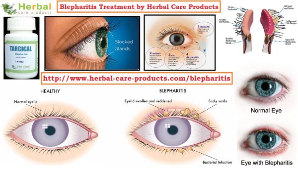 Natural Remedies for Blepharitis Affecting the Eyelids