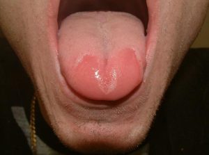 Sore-Red-Tongue1