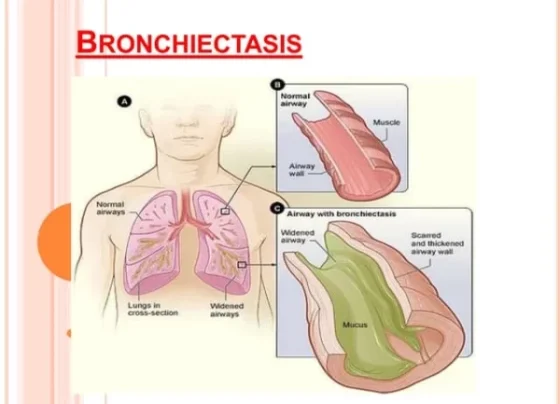Taking Control of Bronchiectasis with Herbal Medicines