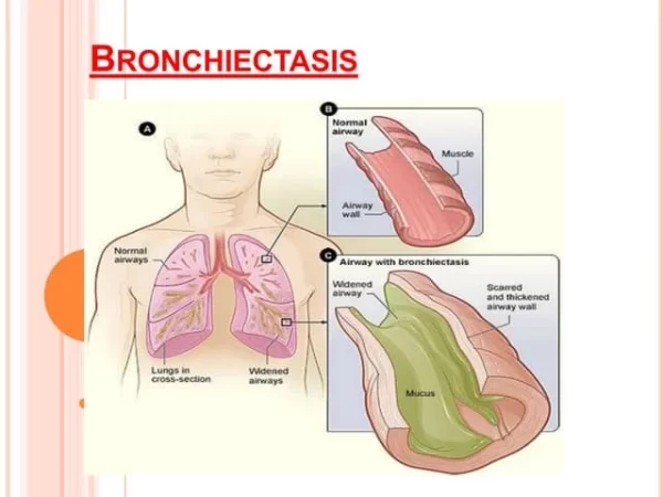 Taking Control of Bronchiectasis with Herbal Medicines