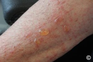 Treating-Bullous-Pemphigoid-Naturally-768x512