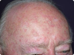 What Is Actinic Keratosis Treatment