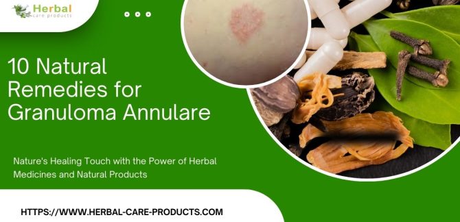 10 Natural Remedies for Granuloma Annulare