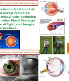 10 Natural Remedies for Retinal Vein Occlusion