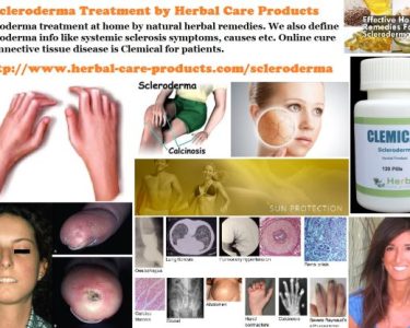 10 Natural Remedies for Scleroderma