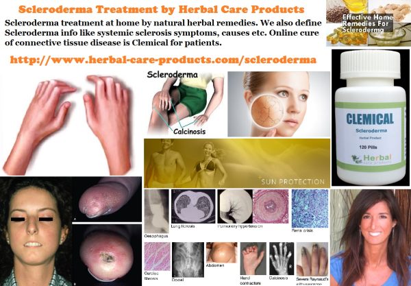 10 Natural Remedies for Scleroderma
