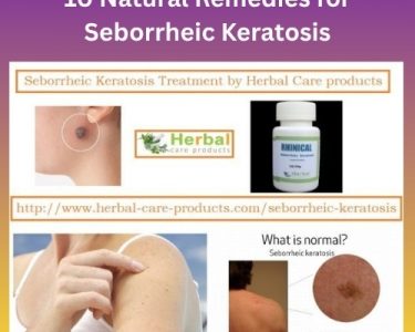 10 Natural Remedies for Seborrheic Keratosis