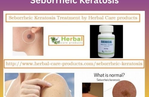 10 Natural Remedies for Seborrheic Keratosis