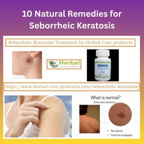 10 Natural Remedies for Seborrheic Keratosis